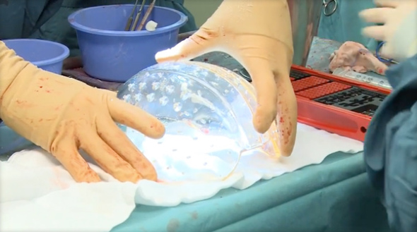 Βίντεο: Ολική αντικατάσταση κρανίου με 3D printed μόσχευμα στην Ολλανδία