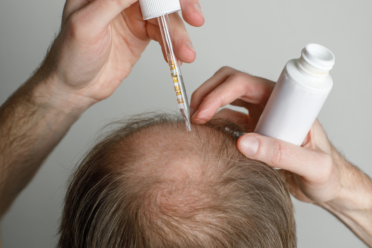 Τέλος η φαλάκρα; Νέος φυτικός ορός υπόσχεται επανεμφάνιση μαλλιών σε λίγες εβδομάδες